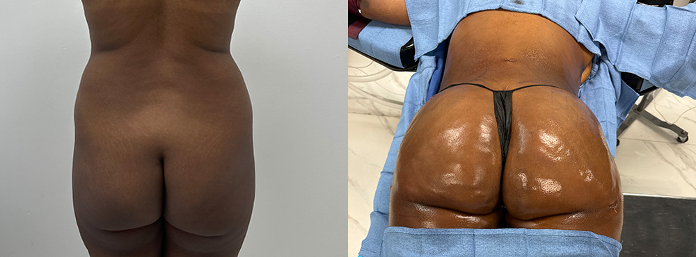 Brazilian Butt Lift before and after