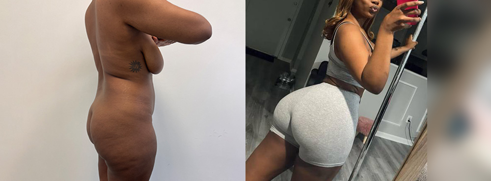Brazilian Butt Lift before and after