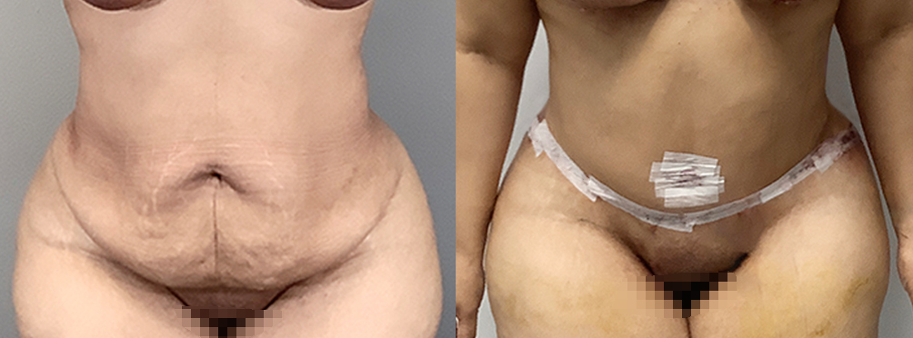 Tummy Tuck Before and After