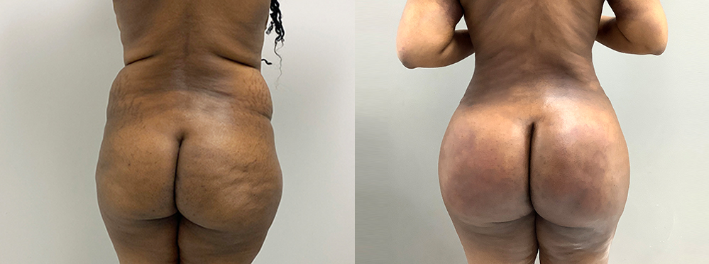 Brazilian Butt Lift Before and After