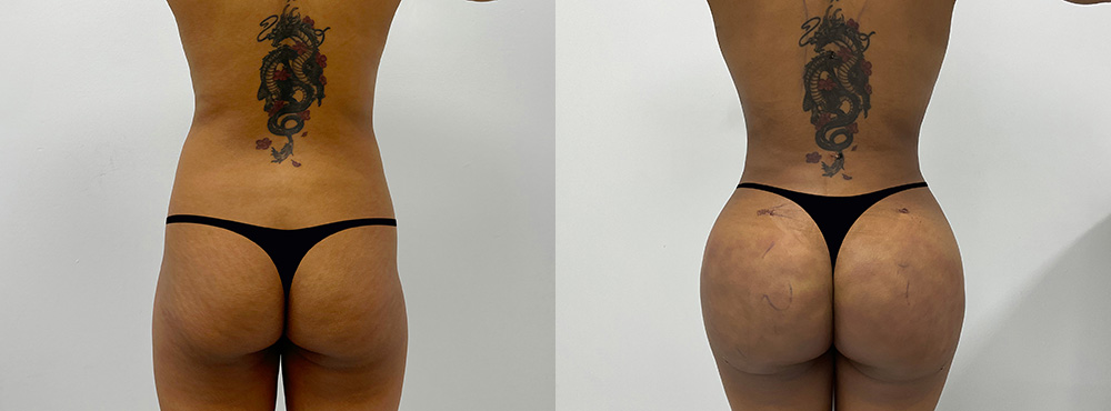 Brazilian Butt Lift Before and After