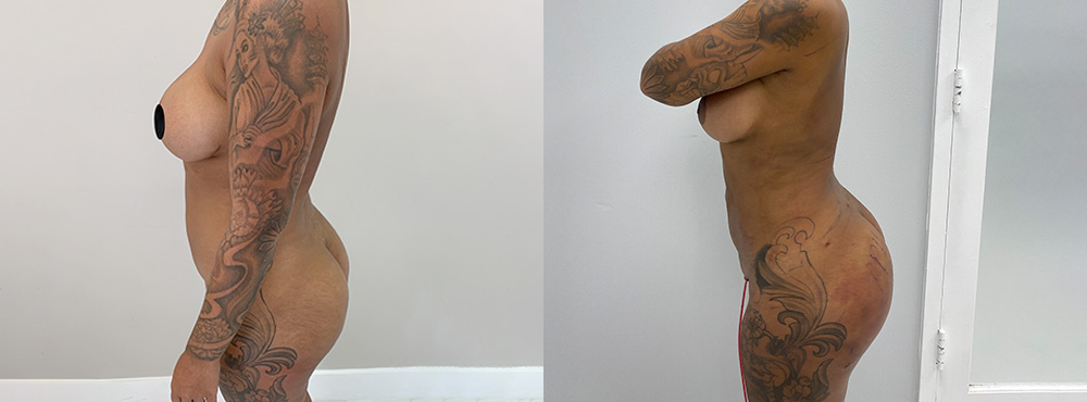 Brazilian Butt Lift Before and After