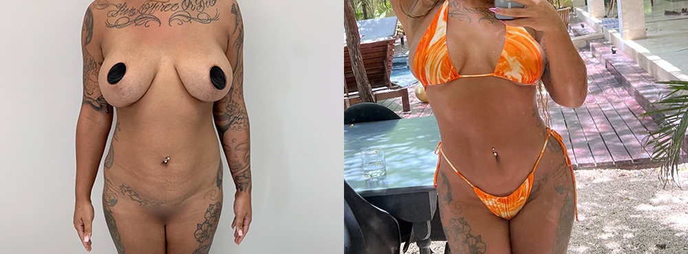 Brazilian Butt Lift Before and After