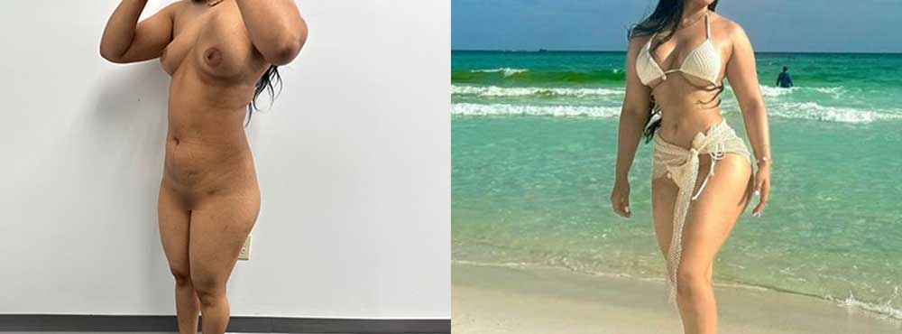 Mommy Makeover Before and After