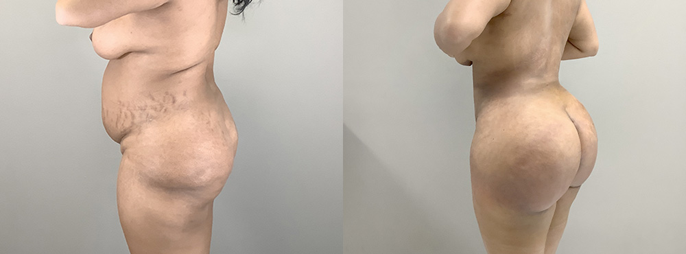 BBL Before and After