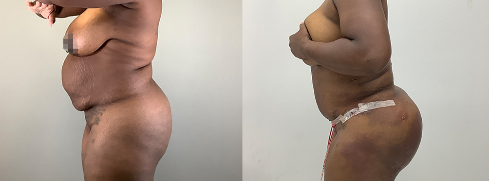 Tummy Tuck Before and After