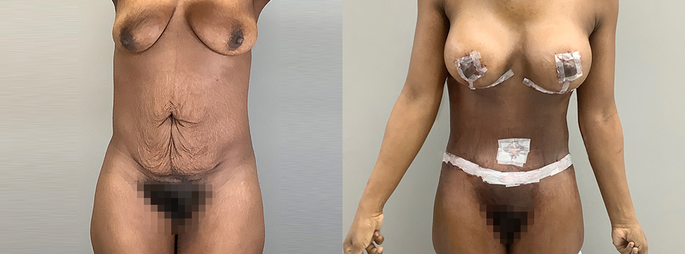 Mommy Makeover Before and After