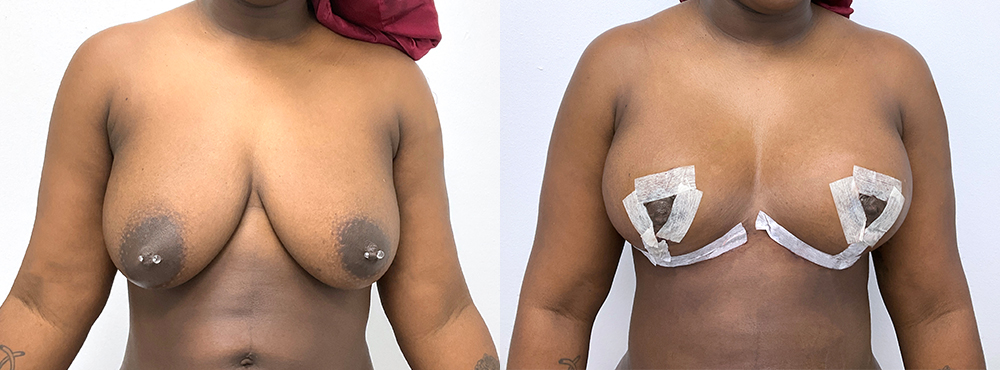 Breast Lift Before and After
