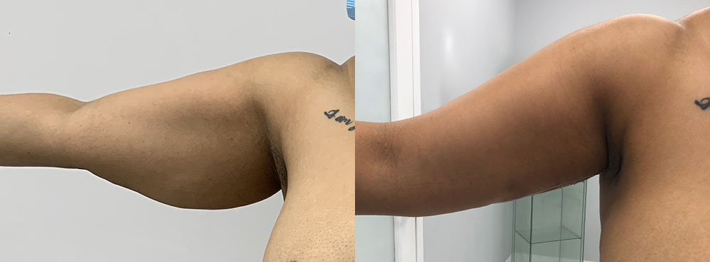 Arm Reduction Surgery Before and after