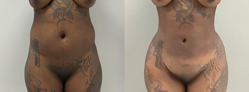 Brazilian Butt Lift Before and After