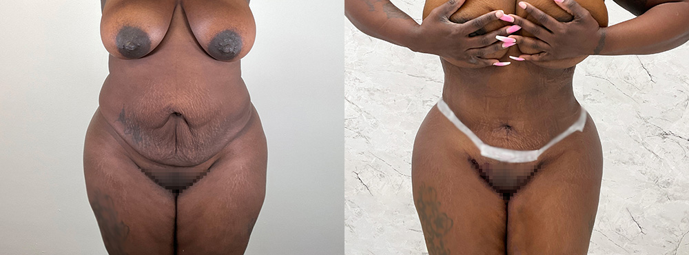 Tummy Tuck Before and After