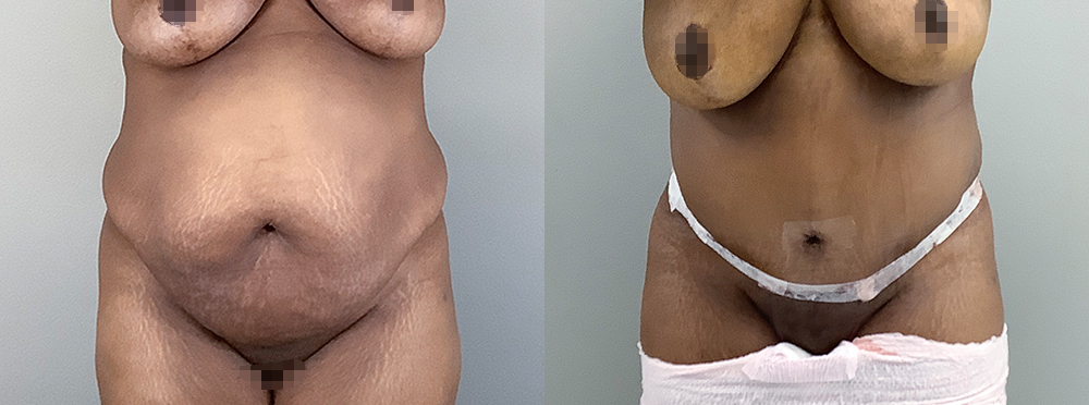Tummy Tuck Before and After