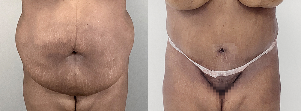 Tummy Tuck Before and After