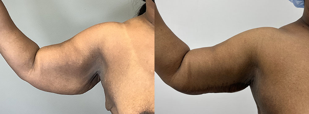 Arm Lift Surgery Before and after Picture