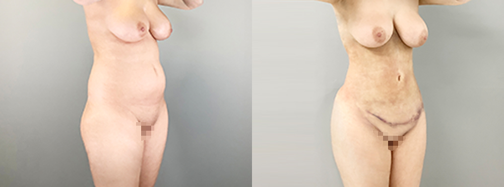 Tummy Tuck Before and After