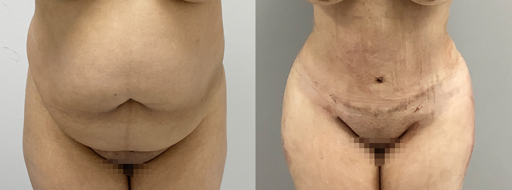 Tummy Tuck Before and After