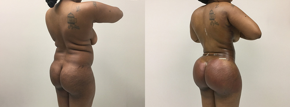 Brazilian Butt Lift Before and After