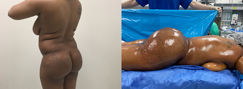 Brazilian Butt Lift Before and After