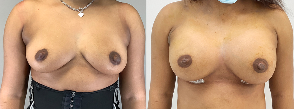 Breast Augmentation Before and After