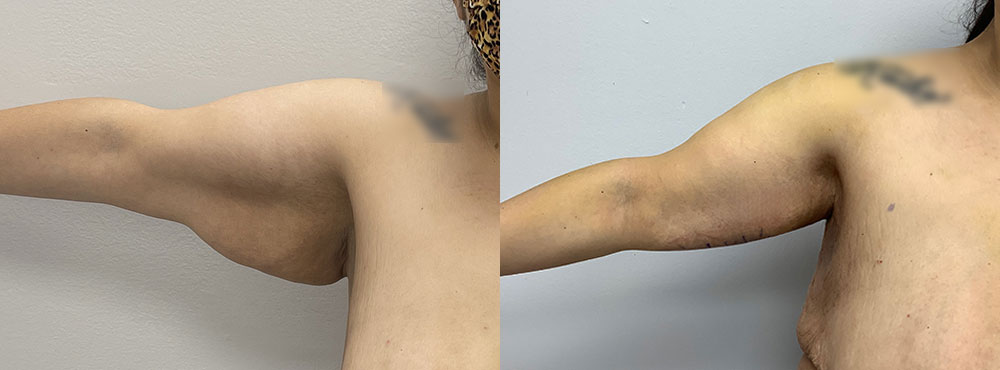 Arm Lift Before and after photo