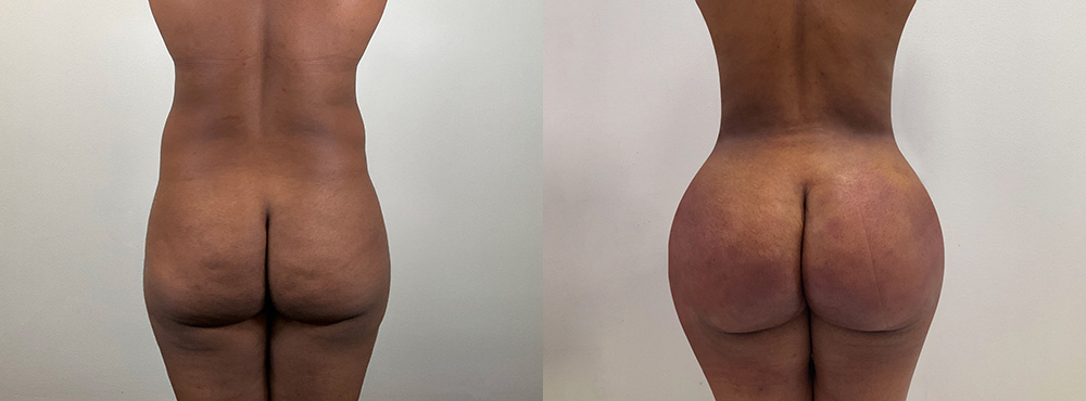 BBL Before and After