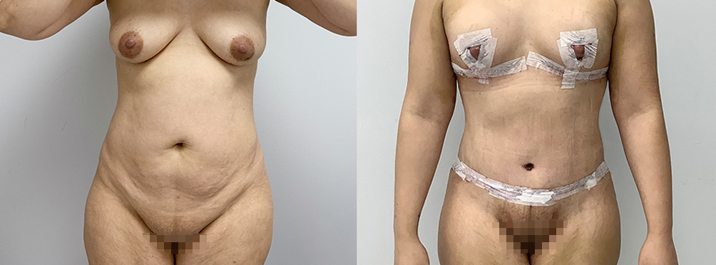 Mommy Makeover Before and After