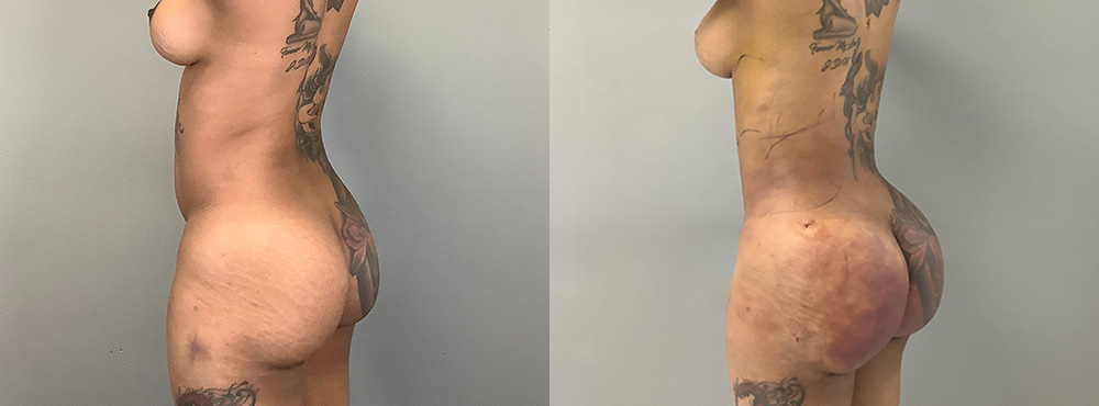 Brazilian Butt Lift Before and After