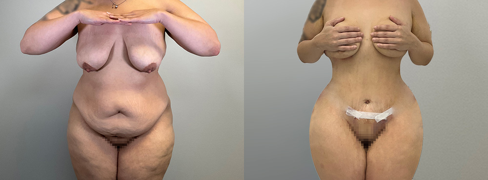 Tummy Tuck Before and After