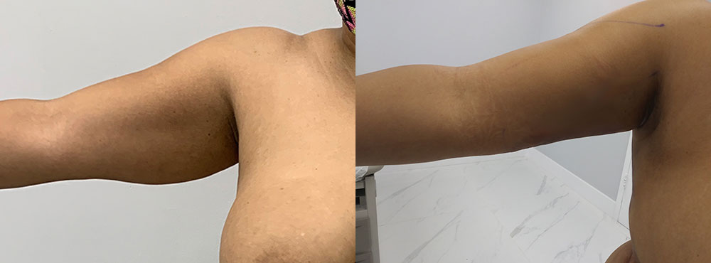 Arm Liposuction Before and After
