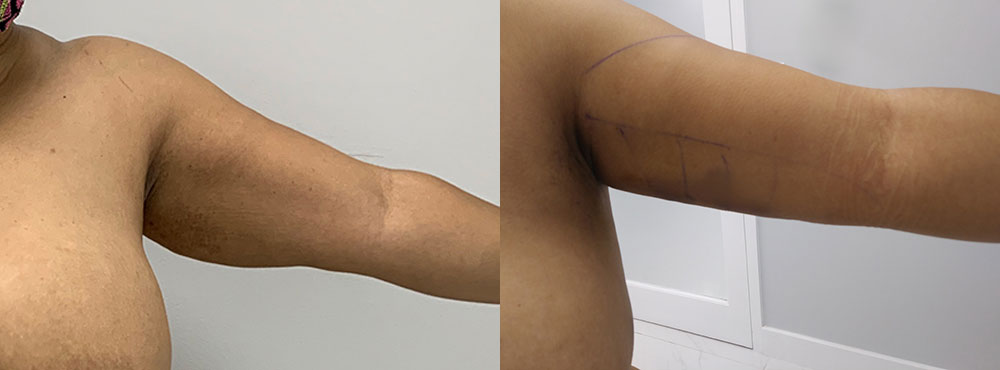 Arm Liposuction Before and After