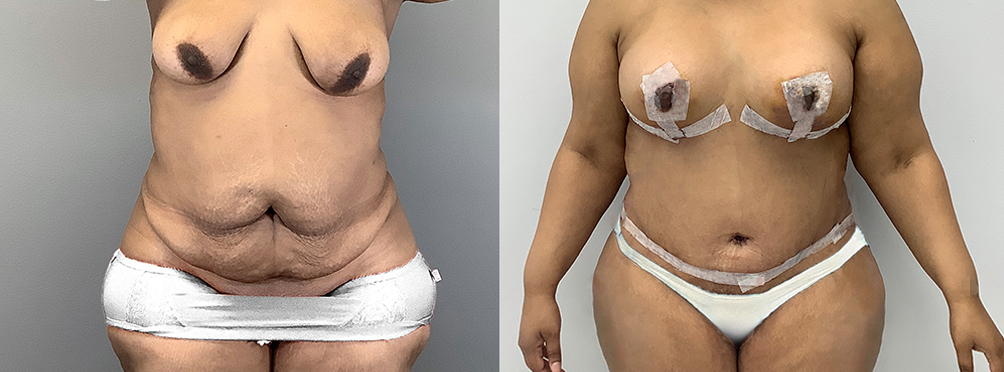 Mommy Makeover Before and After