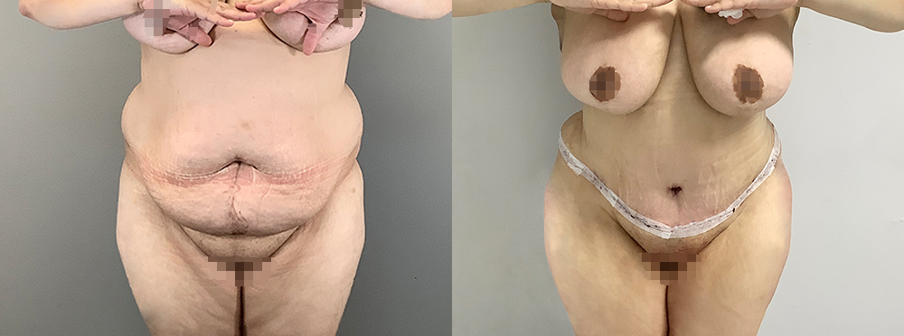 Tummy Tuck Before and After