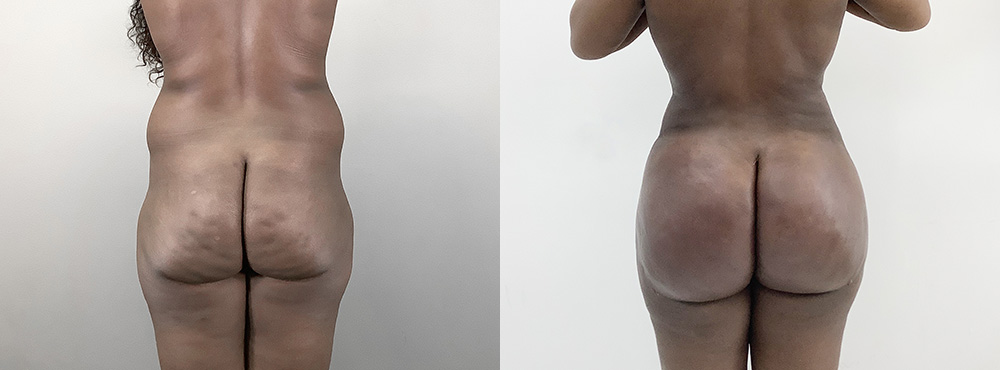 BBL Before and After