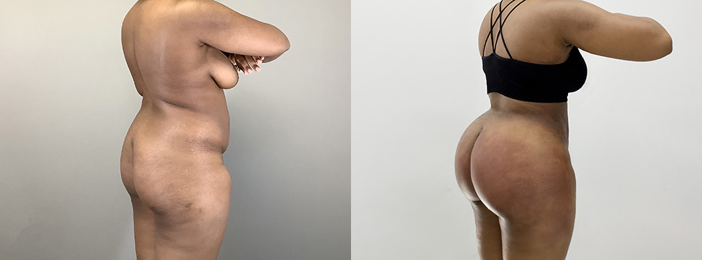 BBL Before and After