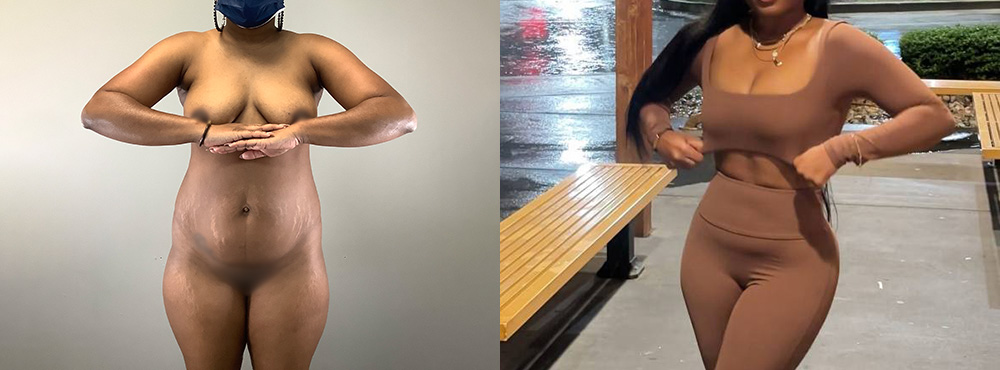 Brazilian Butt Lift Before and After