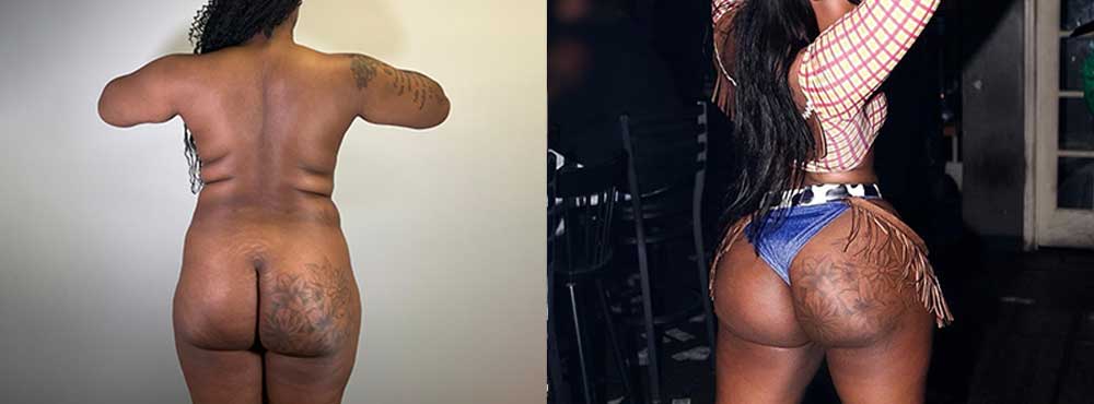 Brazilian Butt Lift before and after