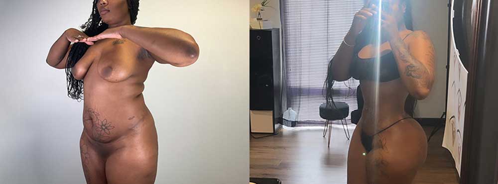 Brazilian Butt Lift before and after