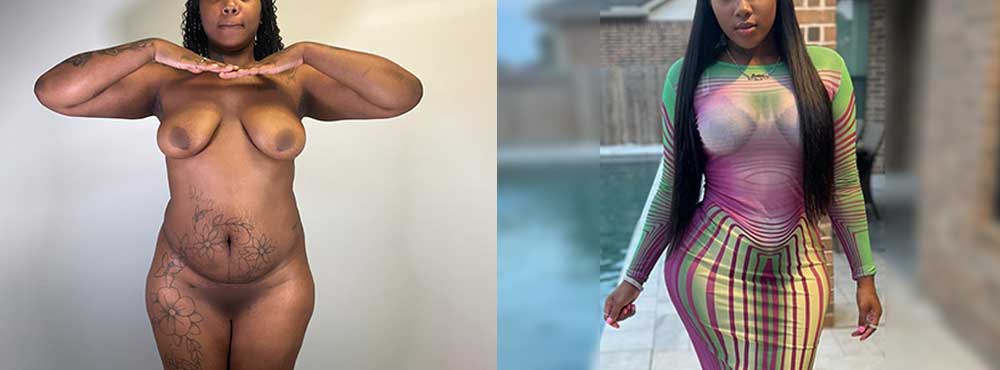 Brazilian Butt Lift before and after