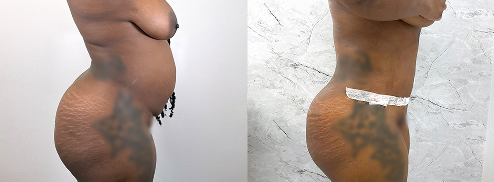 Tummy Tuck Before and After