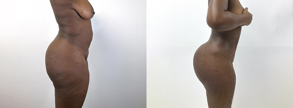 BBL Before and After