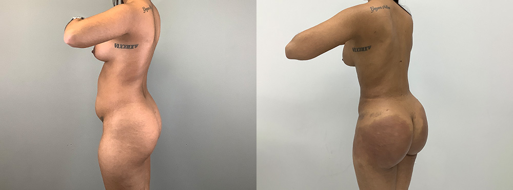 Brazilian Butt Lift before and after