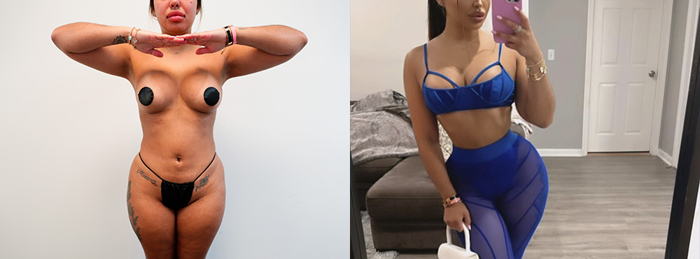 Brazilian Butt Lift before and after