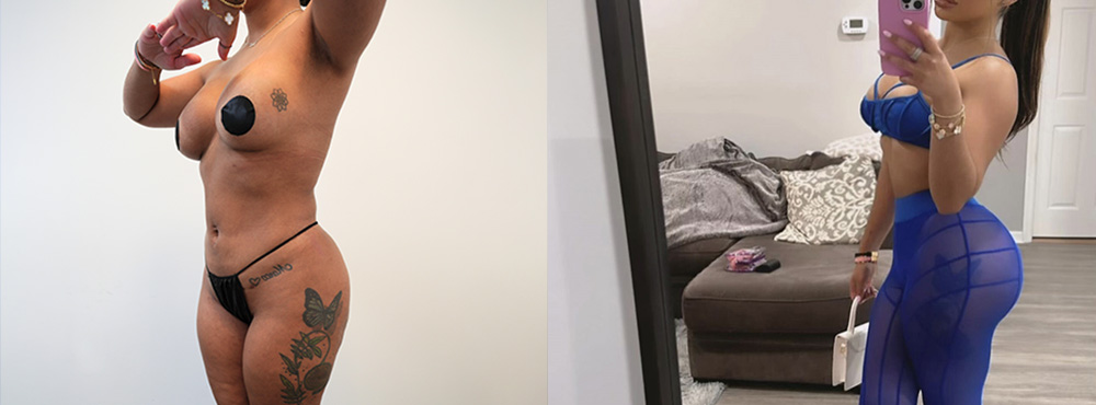 Brazilian Butt Lift before and after