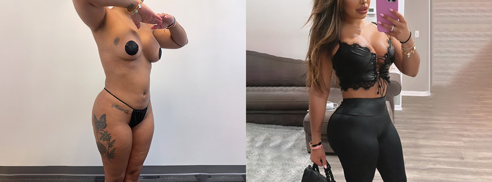 Brazilian Butt Lift before and after