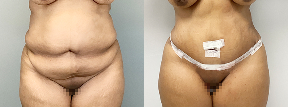 Tummy Tuck Before and After