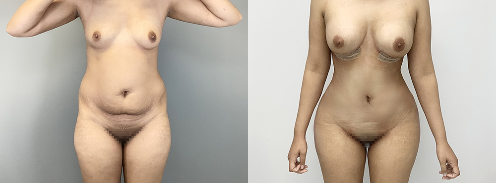 BBL Before and After