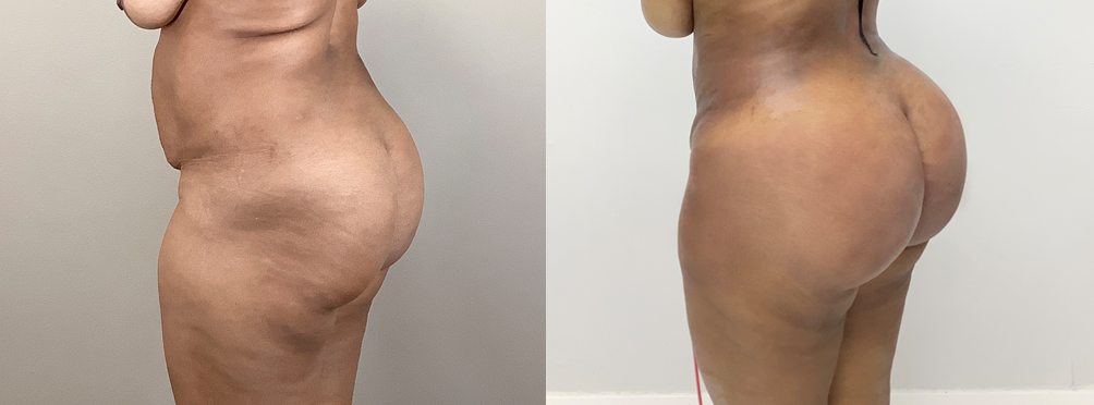Brazilian Butt Lift Before and After