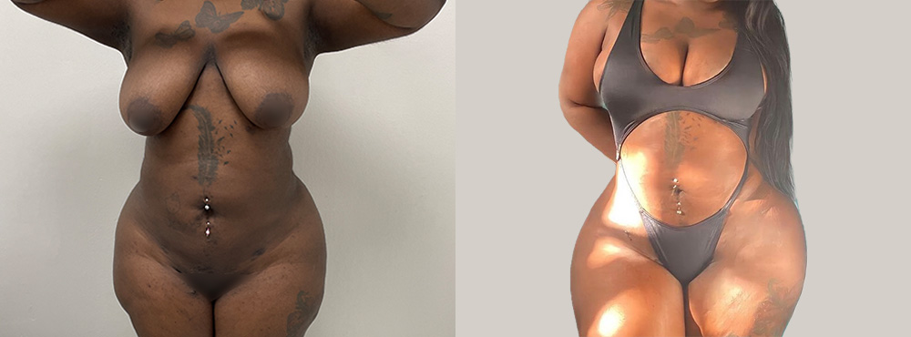 Brazilian Butt Lift Before and After