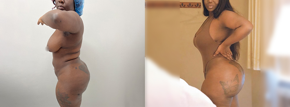 Brazilian Butt Lift Before and After