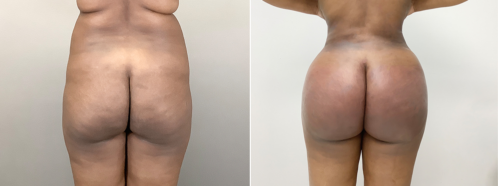Brazilian Butt Lift Before and After